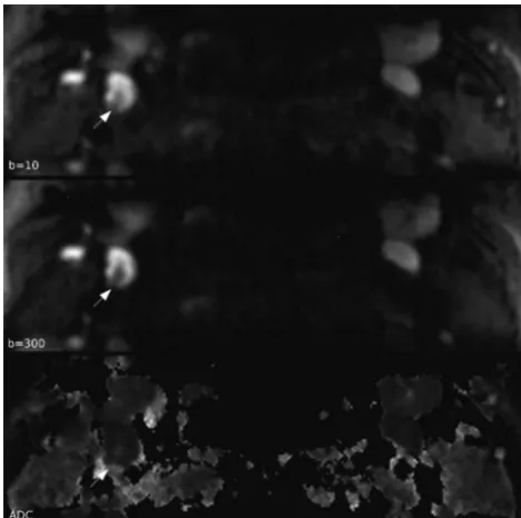 Fig 1. Typical DW images and ADC map. Normal LN hilum is seen as a central linearstructure with low signal intensity on b � 10 and b � 300 images and high signal intensityon ADC map (white arrow) in the right side level 2 LN with a 6.8-mm diameter