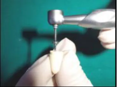 Fig no-11: Decoronation of teeth.     Fig no-12: working length determination 