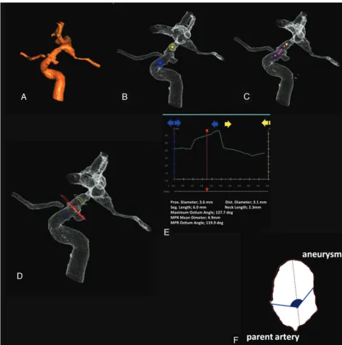 Fig 1. Measurement of the MOA. A, Segmentation of the artery harboring a target aneurysm