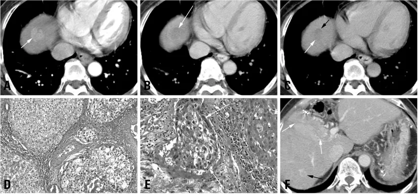 Fig. 1. A 56-year-old female with early recurrent HCC after segmentectomy. The AFP level in a blood sample obtained on the same day as the CTscan was 1076.84 IU/mL