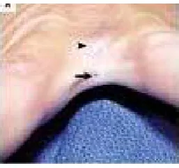 Fig.-3 Pilonidal Sinus in web space of the hand 