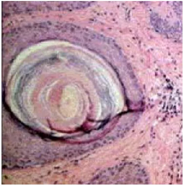 Fig.-5 Keratin accumulation  
