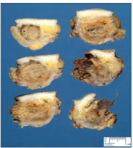 Fig.-7 Cut sections showing pilonidal sinus disease 