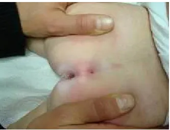 Fig.-9 Picture showing a post anal dimple in an infant 