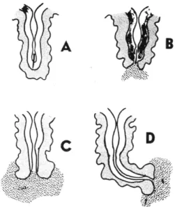 Fig.-10 Pilonidal sinus in post anal dimple 