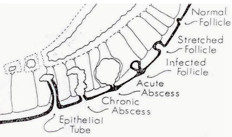Fig.-11 Stages of pilonidal disease 