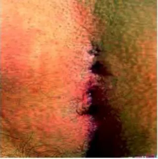 Fig.-14 Pilonidal abscess-note the signs of inflammation 