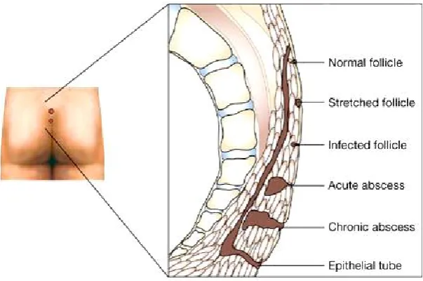Fig.-15 Diagrammatic representation of Pilonidal Disease