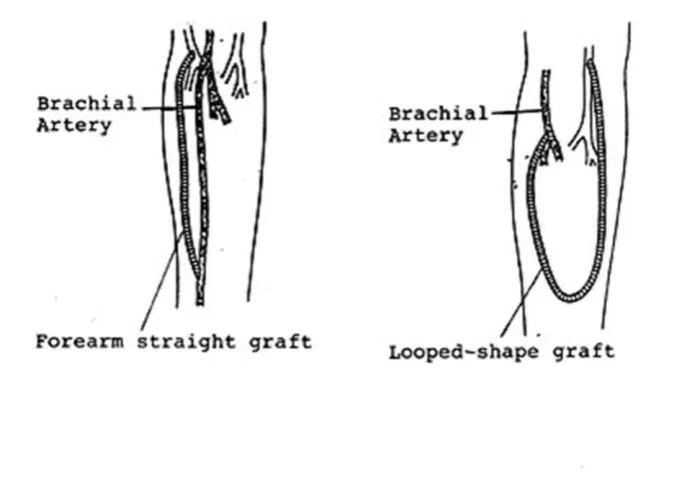 Figure 12: Forearm straight and looped AVGs47
