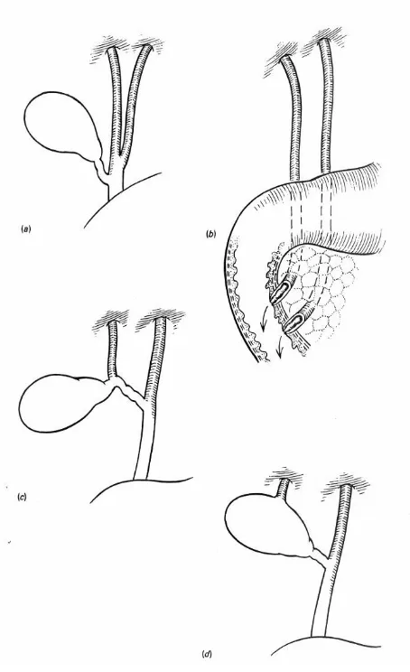 Fig 6: Common duct anomalies 