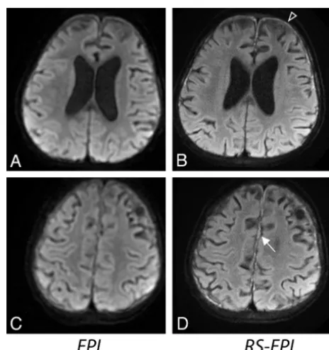 Fig 3. An 18-month-old boy presenting with subdural empyema.with greater diagnostic confidence on RS-EPI
