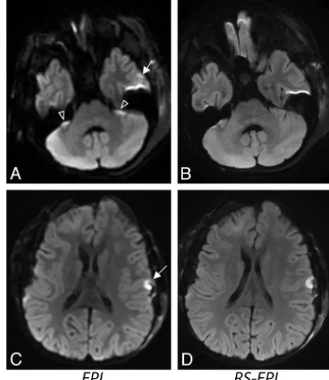 Fig 4. A 10-month-old girl with Leigh disease. RS-EPI shows exquisite resolution at thelevel of the brain stem, specifically in the midbrain
