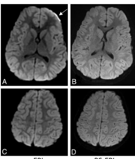 Fig 9. Aglands (arrows, ASSET-accelerated (�2) diffusion-weighted single-shot EPI in 2 different subjects(a 3-year-old girl and a 10-year-old boy) and their corresponding diffusion-weighted RS-EPIscans