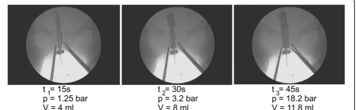 Figure 2 Ballon shape during dilation process of cervix canal in-vivo for different time