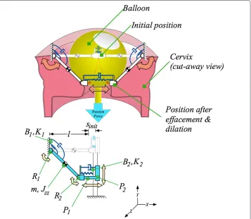 Figure 2 Simplification from a “half-model” cervix to a “quarter-model” cervix. Above is the“half-model” superimposed on a balloon and cervix