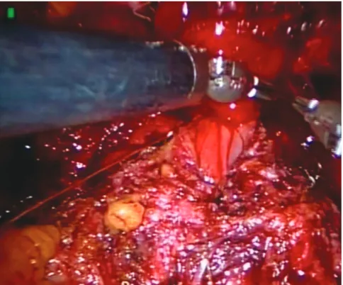 Fig. 1.Photograph of laparoscopic stapler placed across the dorsal venous complex.