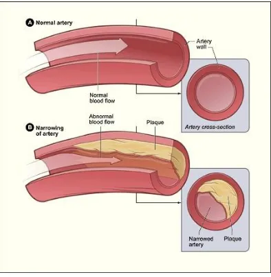 Figure 1.6 Plaque formation in an artery 