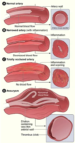 Figure 1.7 Dilation of an artery 