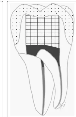 Fig. 2 (right) Schematic figure representing the groups (Group 1.and 2.) restored with the indirect overlay