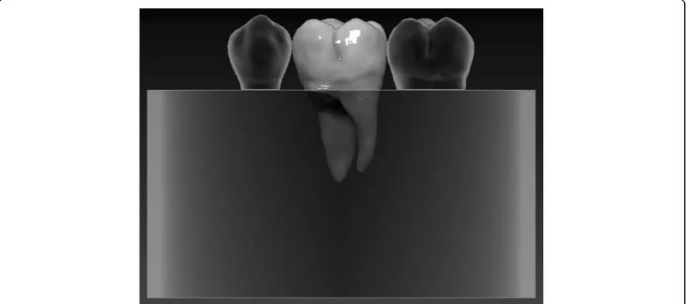 Fig. 3 Schematic figure representing the groups (Group 1. and 3.) with a simulated normal bone level