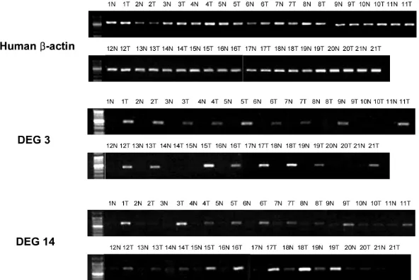 Fig. 5. In 21 PTC samples by RT-PCR, DEG3 and DEG14 were observed to be up-regulated in most tumors