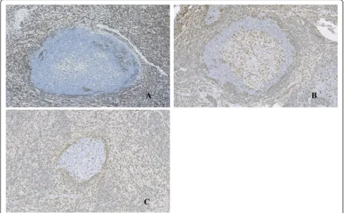 Fig. 7 The parafollicular areas showed immunostaining for CD3 (a) and CD5 (b), and weakly positive immunostaining for Bcl2 (c) (10x)