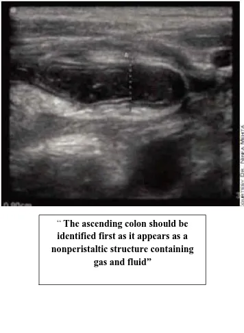 FIG:12 Ascending colon  mimicking  appendix 