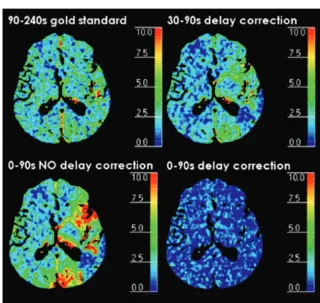 Fig 1. A 75-year-old patient with a left MCA ischemic stroke. Prognostic PCT map showsa mixed pattern of infarct core (red) and penumbra (green).