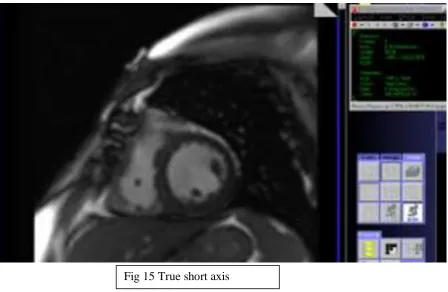 Fig 15 True short axis  