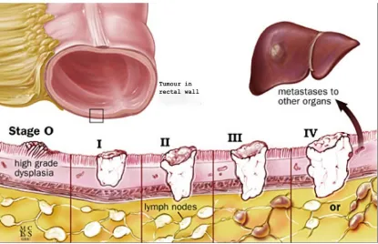 Figure 9: Representation of different stages of rectal cancer in terms of depth of 