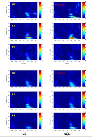 Figure 2Average evoked power for high, low frequent and pseudo words in both hemispheres150 ms and between 15 and 35 Hz