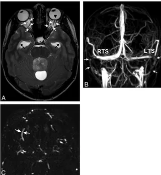 Fig 1. A 15-year-old boy with double vision and reduced acuity has bilateral papilledema.obstructing tumor within the fourth ventricle is found