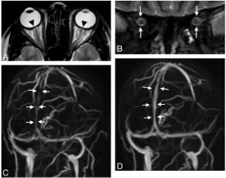 Fig 2. A 30-year-old woman with arterial hypertension and visual disturbances has bilateral papilledema.oblique MIP of MRV shows lengthy narrowings of the intracranial venous sinuses, especially of the superior sagittal sinus (of hypertension