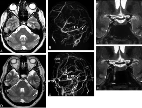 Fig 3. A 28-year-old woman with venous sinus thrombosis secondary to in vitro fertilization