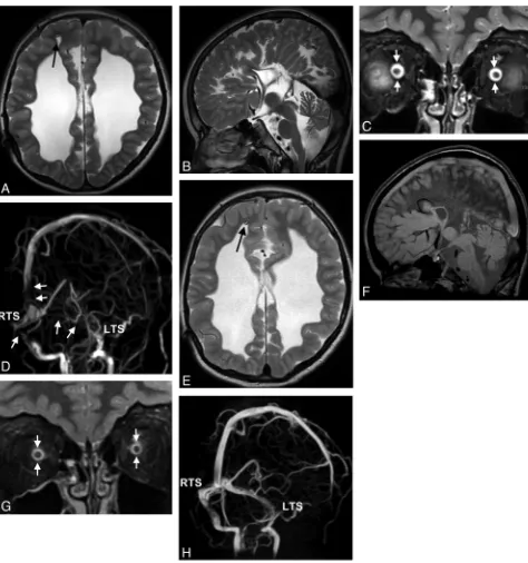Fig 4. Cranial MR imaging of a 7-year-old boy with congenital posthemorrhagic hydrocephalus before (A–D) and 7 days later after (E–H) correction of the distal part of an insufficientventriculoperitoneal shunt (arrows in A and E)