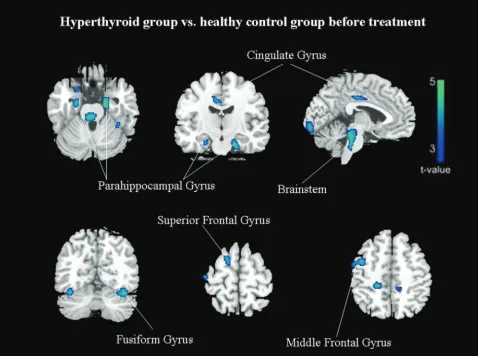Table 3: The relationship of cerebral activity with SAS and SDS inpatients with hyperthyroidisma
