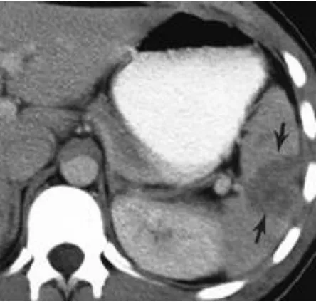 Fig 9- Grade II: capsular tear, 1 to 3 cm parenchymal depth that does 