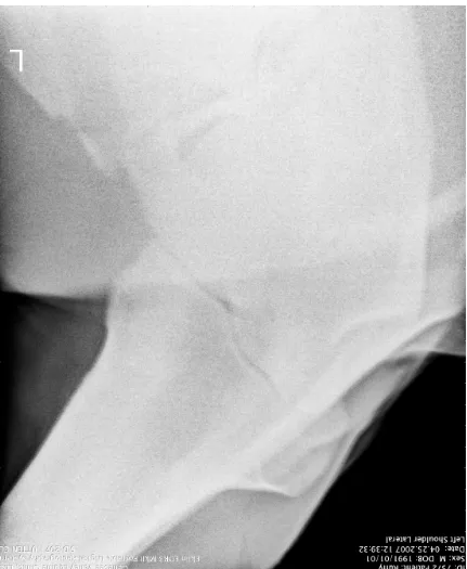 Figure 9. First radiograph of Ruffy’s comminuted fractured humerus. (Radiograph 