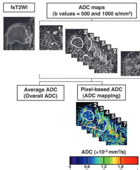 Fig 1. Overall ADC and ADC mapping. MR images are from a 77-year-old man withminutes per patient