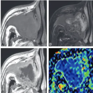 Fig 4. A 65-year-old man with SCC. A, Axial T1-weighted MR image (TR/TE � 500/15 ms) shows tumor with homogeneous signal intensity occupying the right maxillary sinus and extendinginto the surrounding bony structures