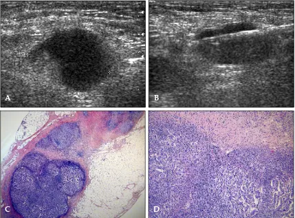 Fig 2. A 50-year-old woman with contralateral metastatic axillary lymph node after right modified radical mastectomy 2years ago