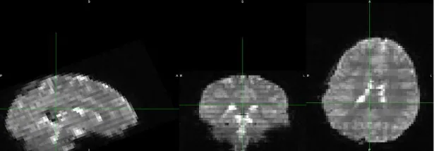 Figure 11. The axial view of a slice of a sMRI scans before and after the skull  information was removed [3]