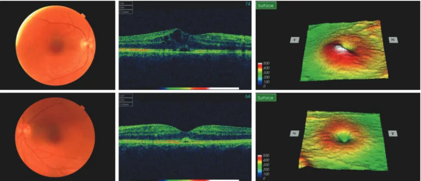 Figure 1: Bilateral cystoid macular oedema was prominent with subretinal ﬂuid at 20 days after initiation of ﬁngolimod