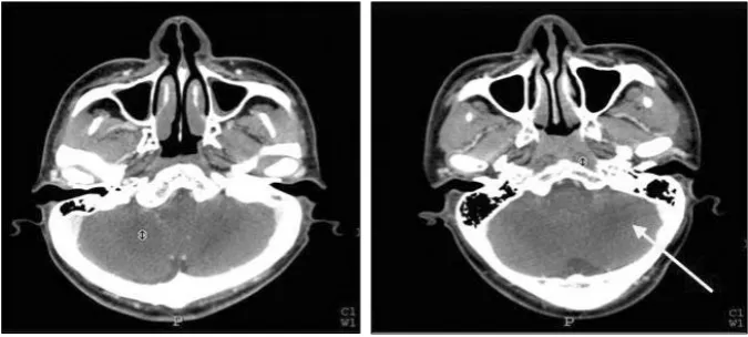 Fig. 6. Routine position (left) and swimmers position (right). There is a break in symmetry in the swimmers position.