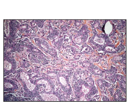 Figure 12. Lauren’s  & WHO  intestinal  type  of  gastric  adenocarcinoma Figure 12. Lauren’s  & WHO  intestinal  type  of  gastric  adenocarcinomaFigure 12