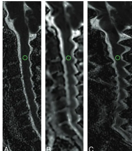 Fig 3. rFOV (A), low-resolution fFOV (B), and high-resolution fFOV ADC maps (C) demon-strating the location of the ROI used for the ADC measurements, placed on the centermostsection of the sagittal images at the level of C2–3.