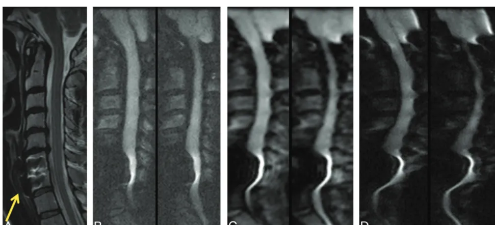 Fig 5. A 42-year-old woman with left-sided arm weakness and multiple posterior disk-osteophyte complexes, the largest of which is located at C4–5 (arrow)