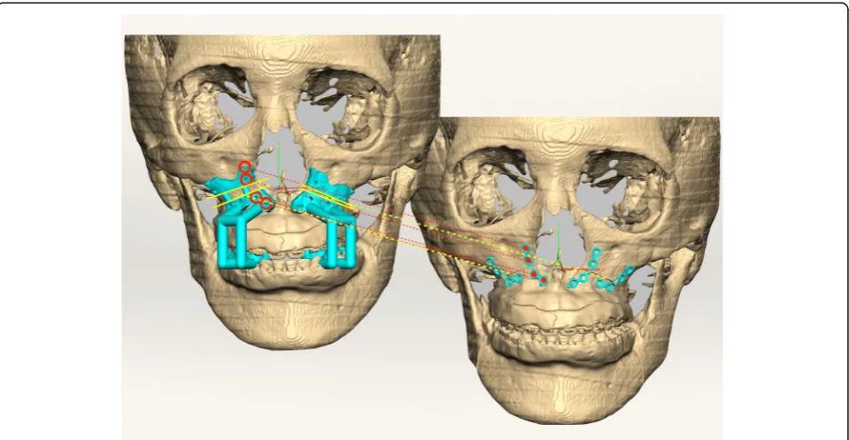 Fig. 1 Workflow of orthognathic surgery using the FaceGide® system