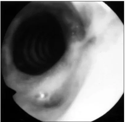 Fig. 4. Tracheoscopic image of postoperative subglotticstenosis.