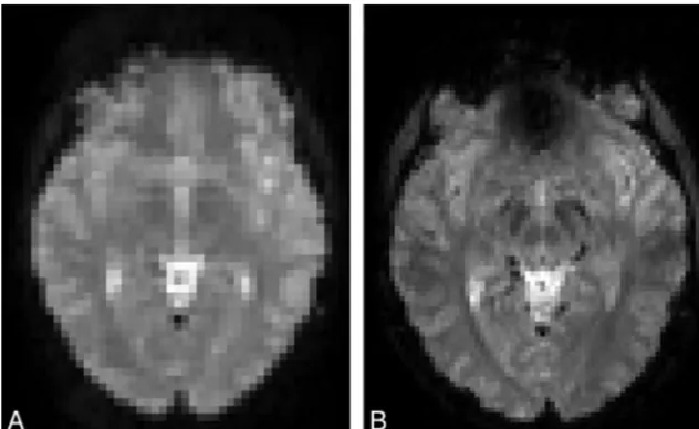 Fig 1. Examples of EPI sections of the same subject for the open 1T MR imaging scanner (A) and the 3T MR imaging scanner (B).
